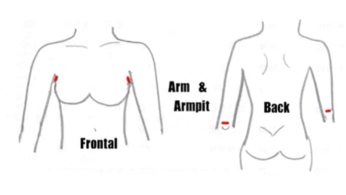 Arm Liposuction