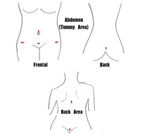 Tummy Liposuction