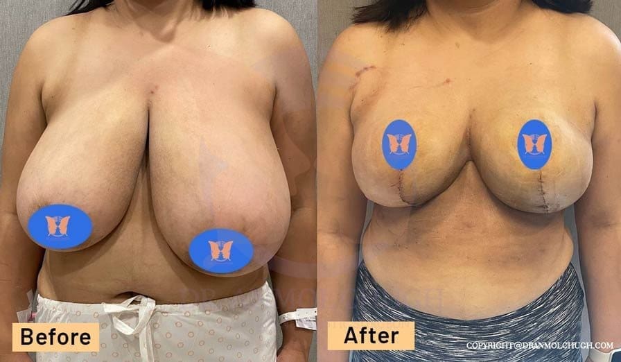 Breast Reduction Surgery Results