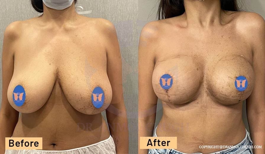 Breast Reduction Surgery Results