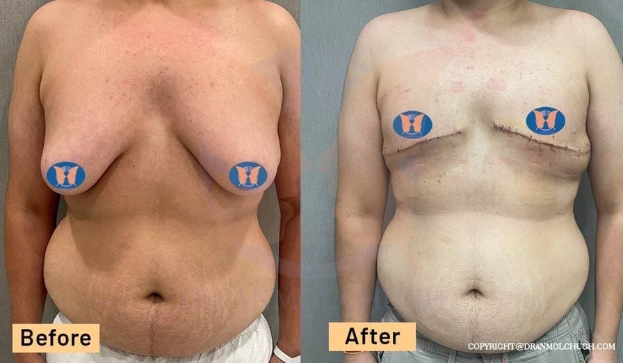 Gynecomastia Patient Result