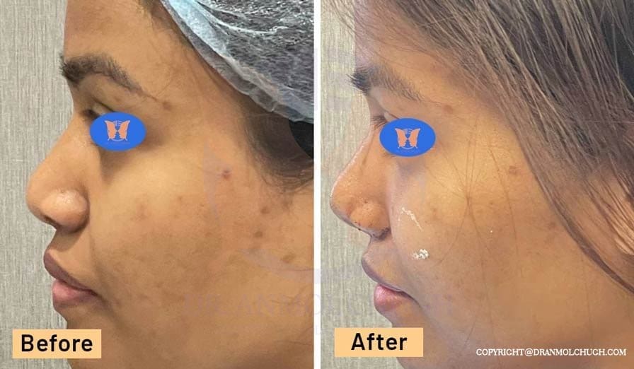 Rhinoplasty Nose Job Results