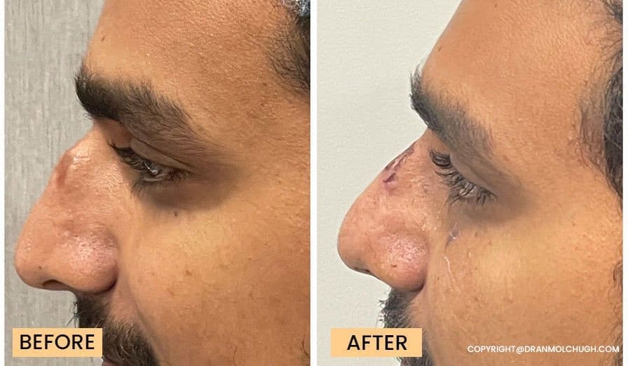 Rhinoplasty Before After Dr Anmol Chugh