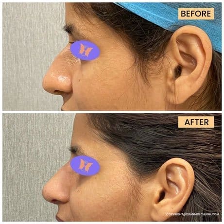 Rhinoplasty Surgery for Female - by Dr Anmol Chugh
