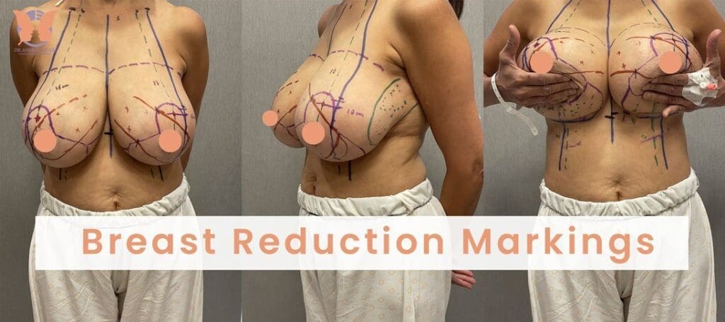 Breast Reduction Surgery Markings