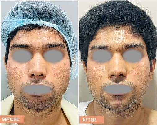 22 year old male with small chin (microgenia) wanted sharper jawline.
