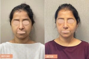 Buccal Fat Removal for Female