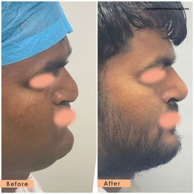 Cleft Nasal Deformity and Rhinoplasty results in india