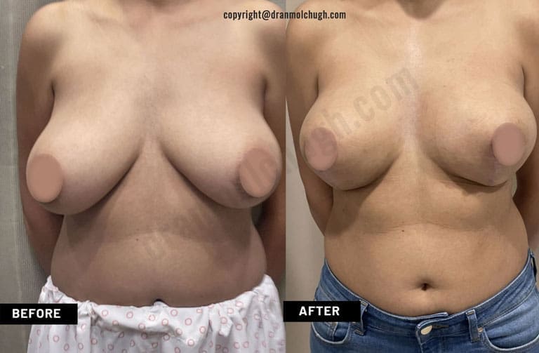 Breast Lift ( Auto-augmentation Mastopexy)