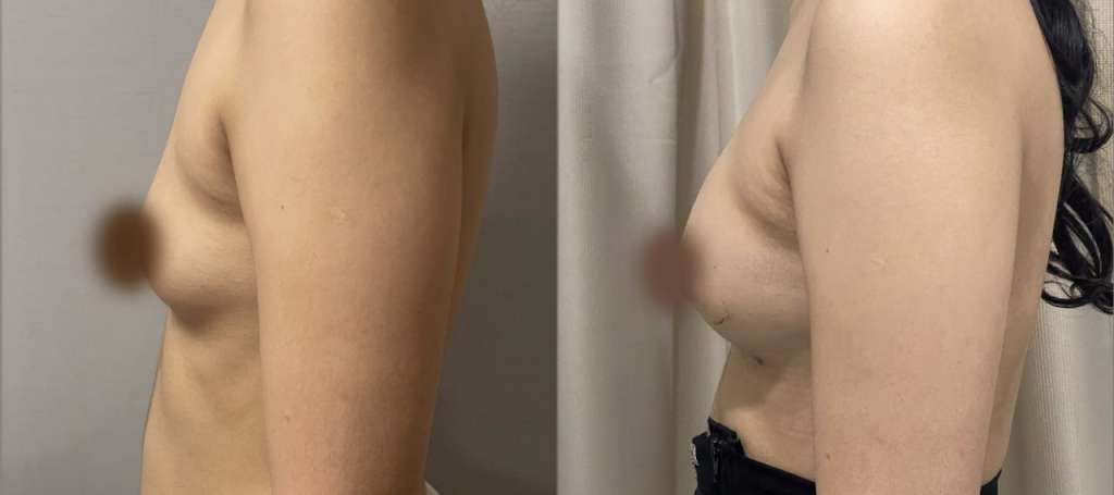 Breast Fat Transfer