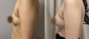 Breast Fat Transfer