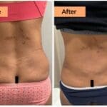 Back Liposuction