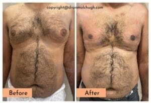 gynecomastia surgery in india