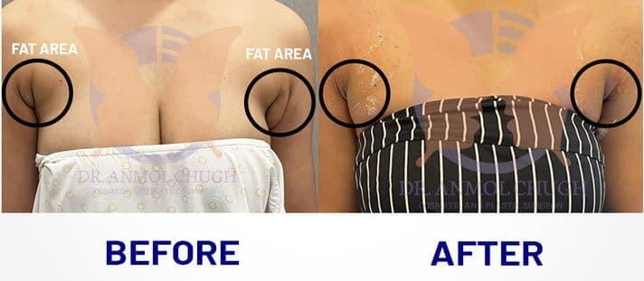 Axillary breast fat removal