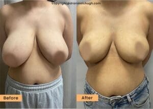 Breast Reduction Surgery