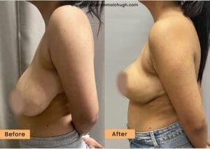 Breast Reduction Surgery in Gurgaon