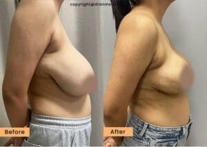 Breast Reduction Surgery in India
