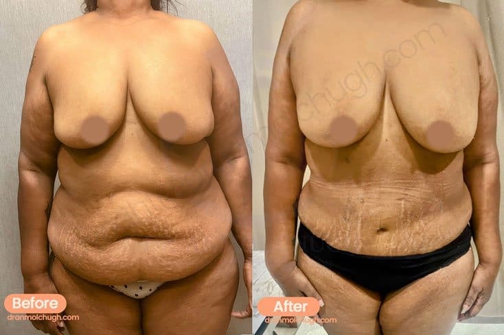 Tummy Tuck surgery for Indian