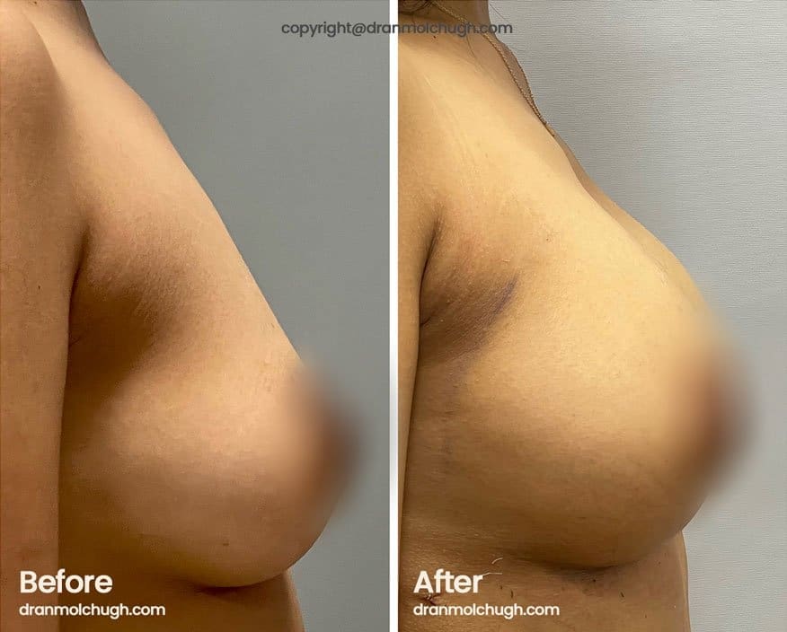 Natural Breast Augmentation