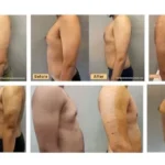 gynecomastia before and after real patient images