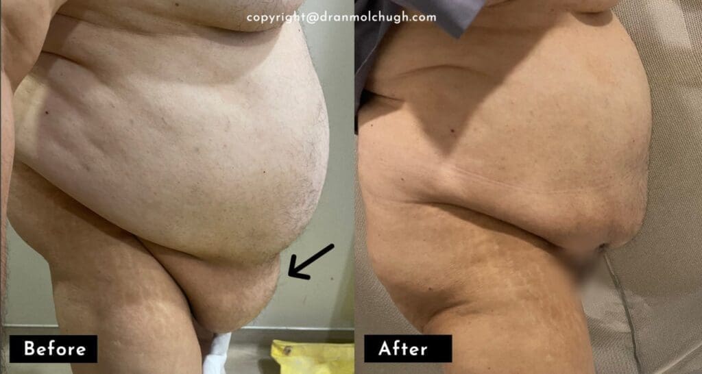 Panniculectomy Surgery Results in Delhi NCR Panniculectomy Surgery Results in Delhi NCR