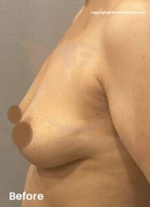 small breast before left