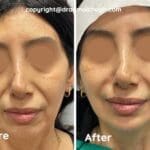 Chin and Jaw Fillers in Gurgaon