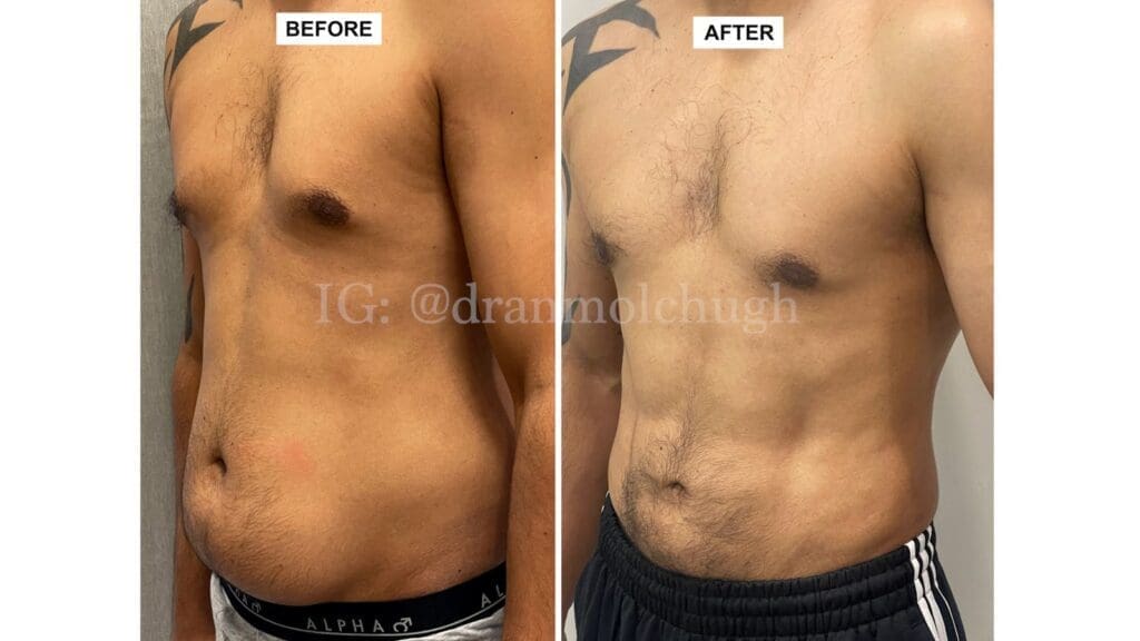 Hi-Definition Liposuction journey for a 40-year-old male