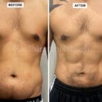 High-Definition Liposuction