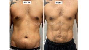 Hi definition Liposuction