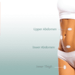 Understanding liposuction side effects and recovery process