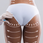 Understanding the side effects of Brazilian Butt Lift surgery