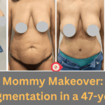 Before and after Mommy Makeover: abdominoplasty and breast augmentation in a 47-year-old female