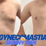 Gynecomastia in skinny men – causes, symptoms, and treatment options