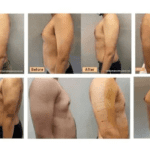 Gyno in Indian men – causes, symptoms, and treatment options