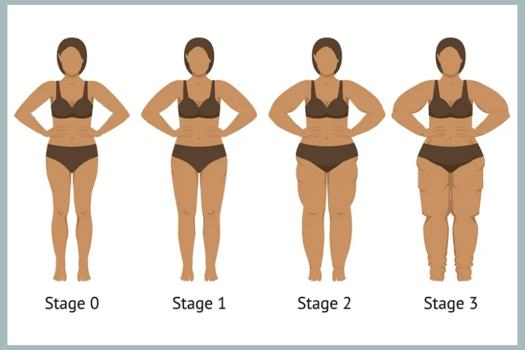 Lipedema Surgery