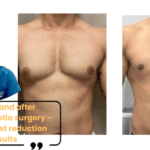 Before and after gynecomastia surgery – Male breast reduction results