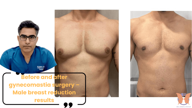 Before and after gynecomastia surgery – Male breast reduction results