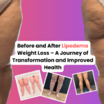 Before and after lipedema weight loss – A journey of transformation and improved health