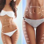 Illustration of how liposuction works to remove excess fat from the body