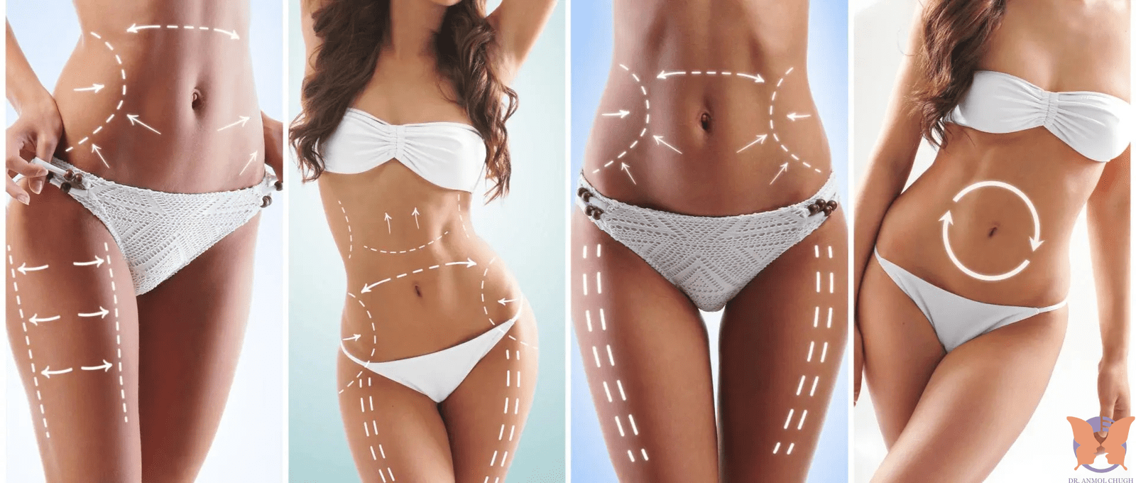 Illustration of how liposuction works to remove excess fat from the body
