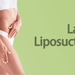 Laser liposuction for stomach – Effective fat removal and body contouring
