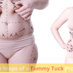 Steps of a tummy tuck procedure – From consultation to recovery