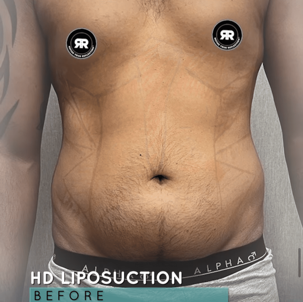 InstaGram HD Liposuction Image