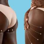 Brazilian Butt Lift in India – Popular choice among international trendsetters for curvy transformations