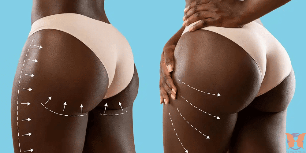 Brazilian Butt Lift in India – Popular choice among international trendsetters for curvy transformations