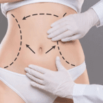 Can Liposuction Be Done All at Once? What You Need to Know