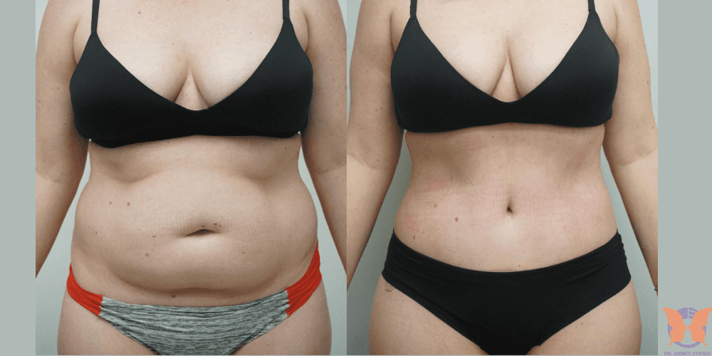 Liposuction before and after results – visible transformation of abdomen and waistline