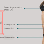 Mommy makeover procedure explained – combination of tummy tuck, breast surgery, and liposuction after pregnancy
