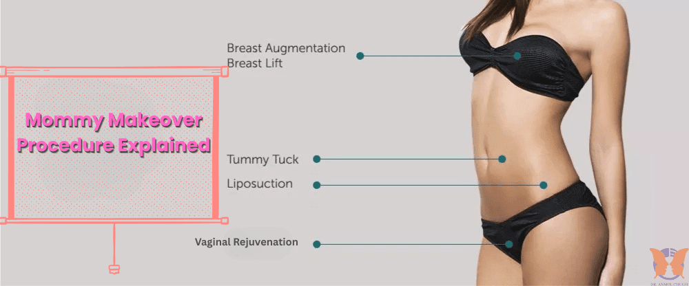 Mommy makeover procedure explained – combination of tummy tuck, breast surgery, and liposuction after pregnancy